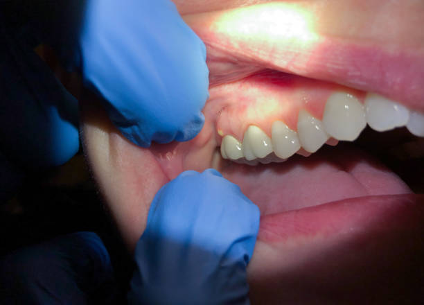 Best Dental Abscess Treatment in Gregory, TX
